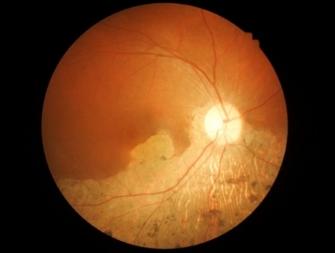 The researchers hope their study will help develop new treatments for progressive diseases that damage the retina, such as age-related macular degeneration.